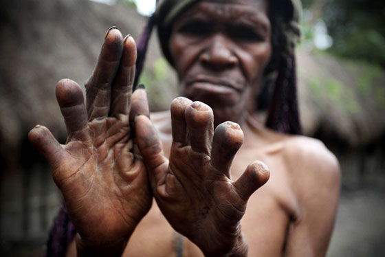 dani tribe no fingers